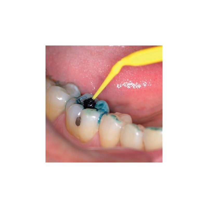 Refill indicator carie CTX Expose XF Blue