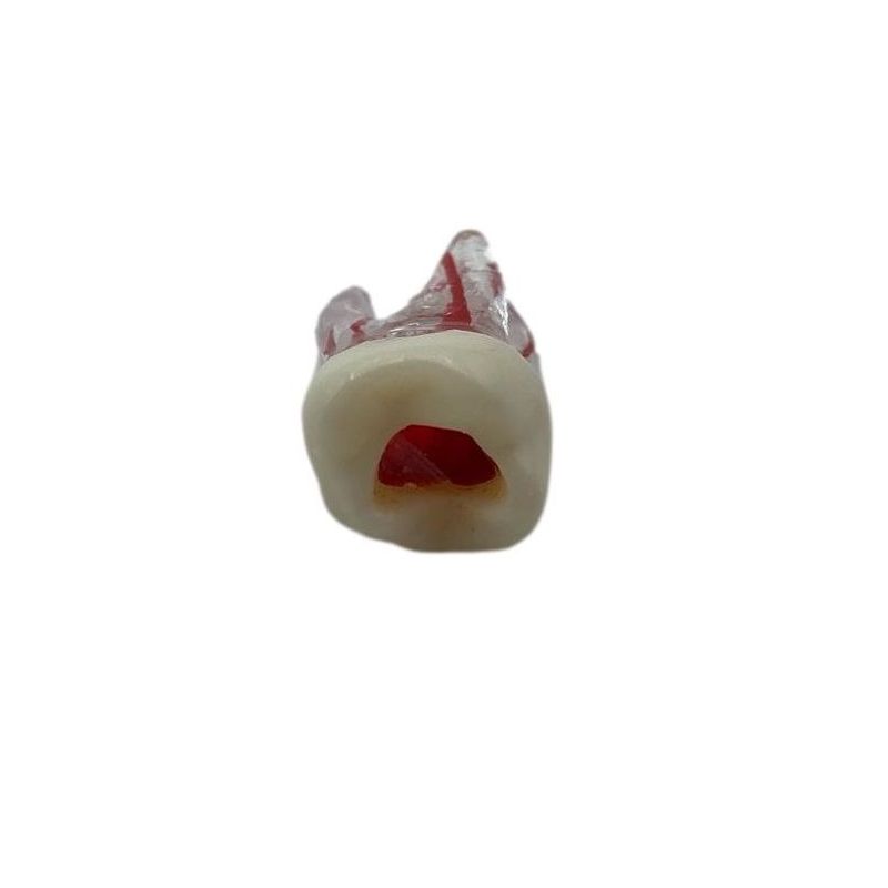 Bloc training canal radicular coroana deschisa