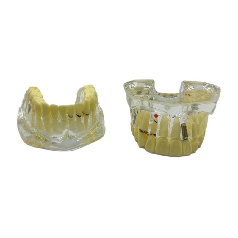 Model studiu implant si restaurare