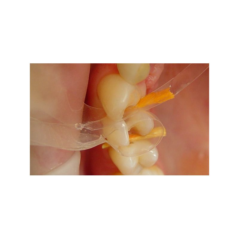 Matrici conturate autoadezive premolari