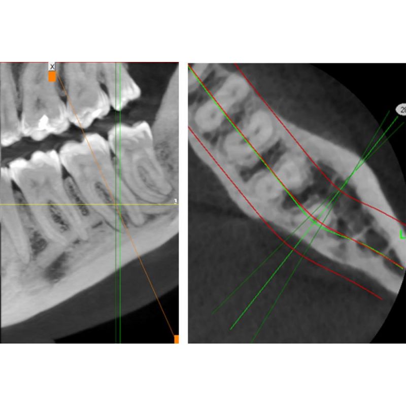 Aparat CBCT Stellaris 3D cu brat cefalometric (XDI-350)