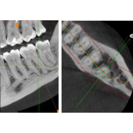 Aparat CBCT Stellaris 3D cu brat cefalometric (XDI-350)