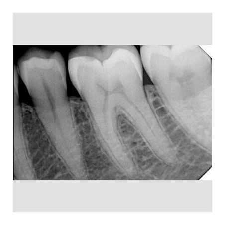 Senzor RVG StarX Pro XDI-402 marimea 2