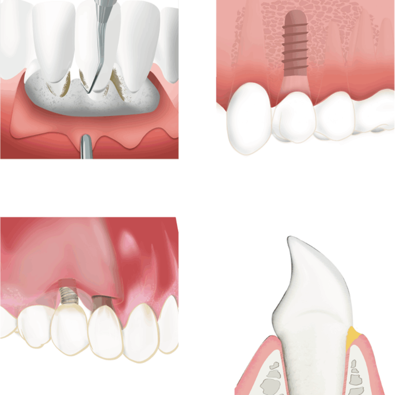 Pansament intraoral parodontal Bona-Pac 10 buc