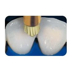 Occlubrush point refill